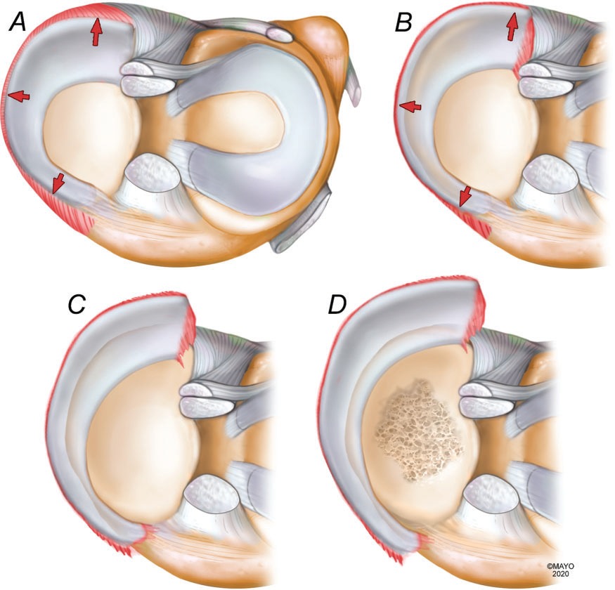 内側半月板後根断裂は半月板逸脱の原因か 結果か 膝の整形外科医 学びの部屋