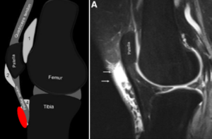 膝滑液包炎の原因は何ですか?