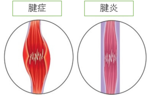 大腿四頭筋腱炎は治るまでどれくらいかかりますか?