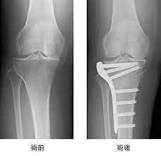 高位脛骨骨切り術（HTO手術）について | ひざの痛みと治療方法 | オリンパス テルモ バイオマテリアル株式会社